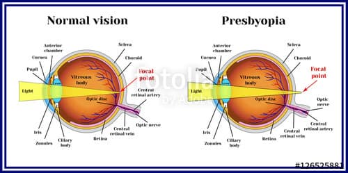 Refractive errors eyeball. Presbyopia