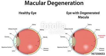 Age Related Macular Degeneration