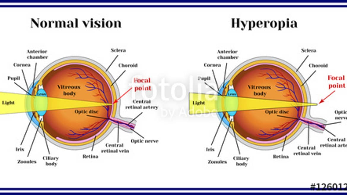 Hyperopia – Long sightedness