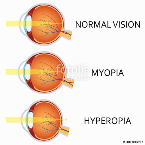 Myopia: Short Sightedness