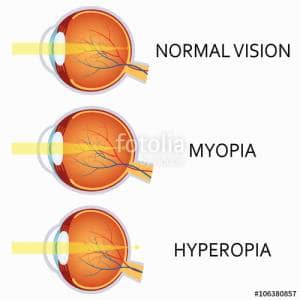 Optical human eye defects. Myopia and hyperopia.