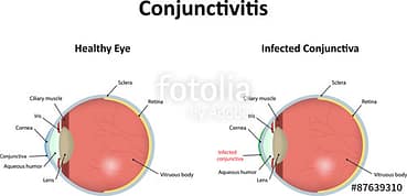 Conjunctivitis: Inflammation Of The Conjunctiva
