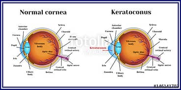 Keratoconus – A Change In Your Eye’s Shape