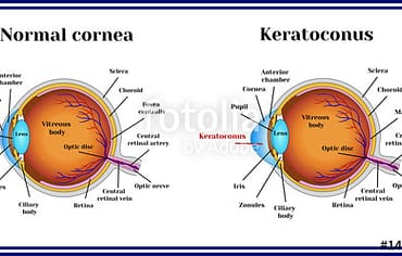 Keratoconus – A Change In Your Eye’s Shape