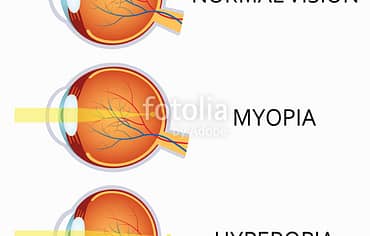 Myopia: Short Sightedness