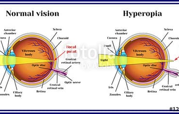 Hyperopia – Long sightedness