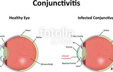 Conjunctivitis: Inflammation Of The Conjunctiva
