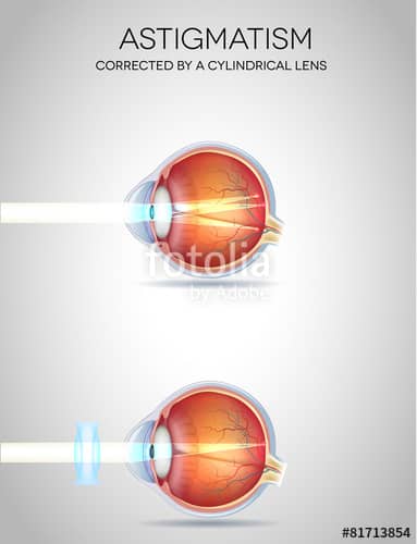 Eye vision disorders - Astigmatism